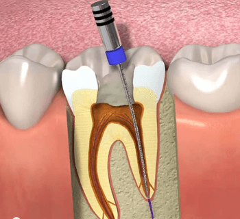 Endodontia ou Tratamento de Canal (raiz/nervo do dente)